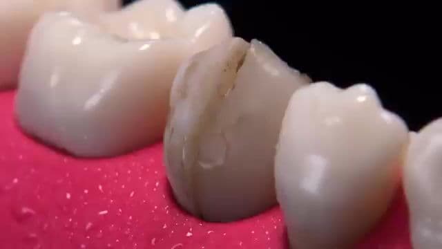 Mi viaje de implantes dentales en Tijuana