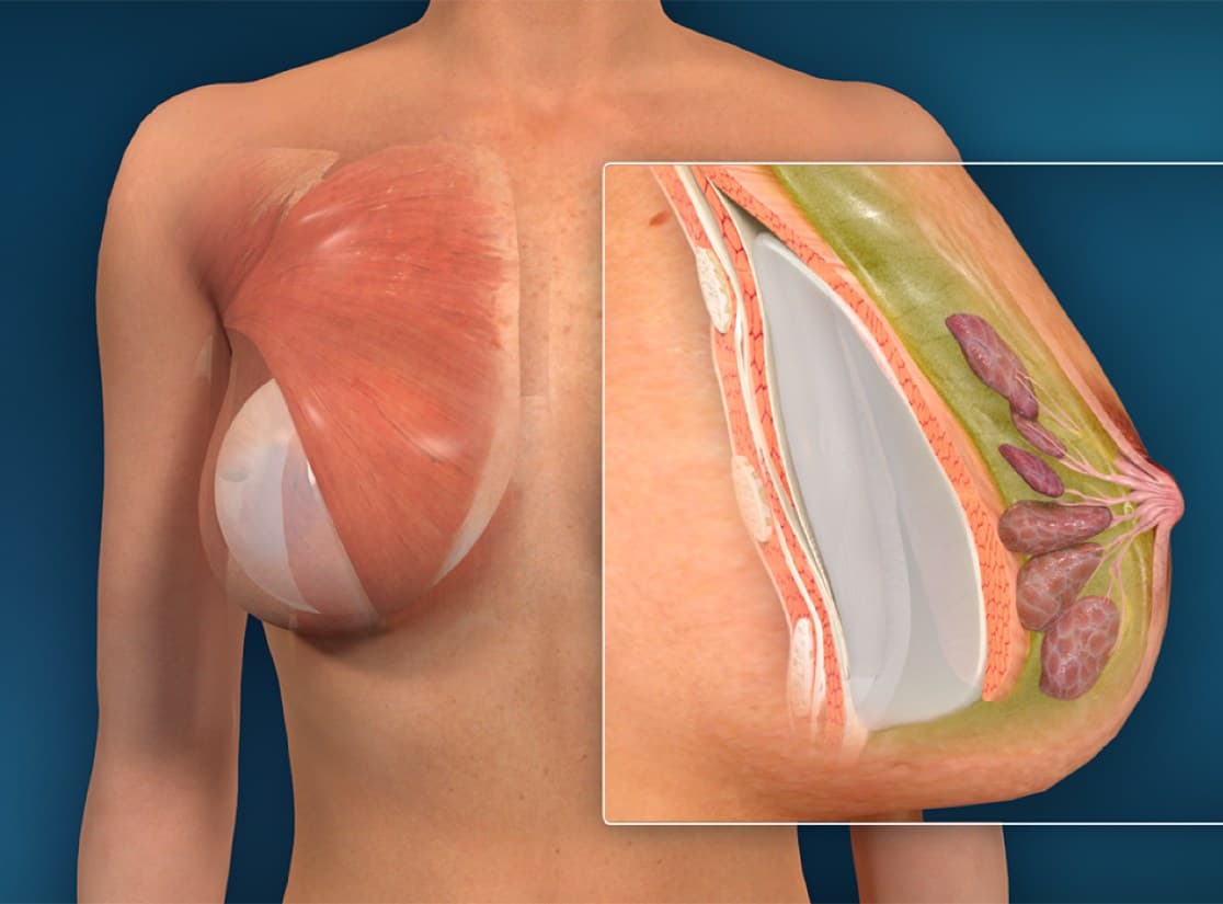 Breast Augmentation