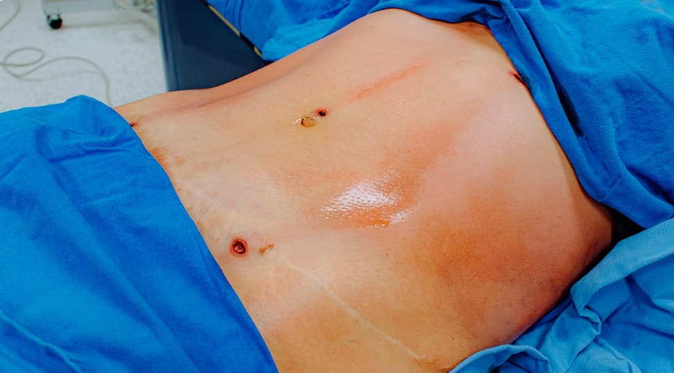 Liposculpture